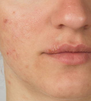 Skin Issues? It Could Something You’re Eating